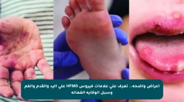 أعراض واضحة.. تعرف على علامات فيروس HFMD على اليد والقدم والفم وسبل الوقاية الفعالة